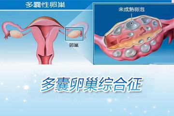 卵巢囊肿危害