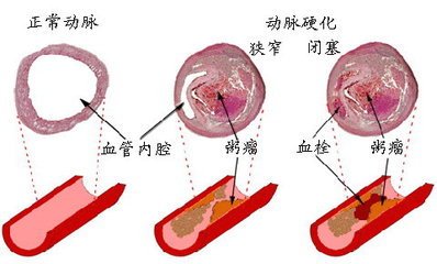 动脉硬化有哪些表现？