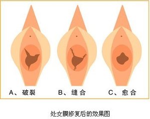 怎么可以做好处女膜修复手术呢